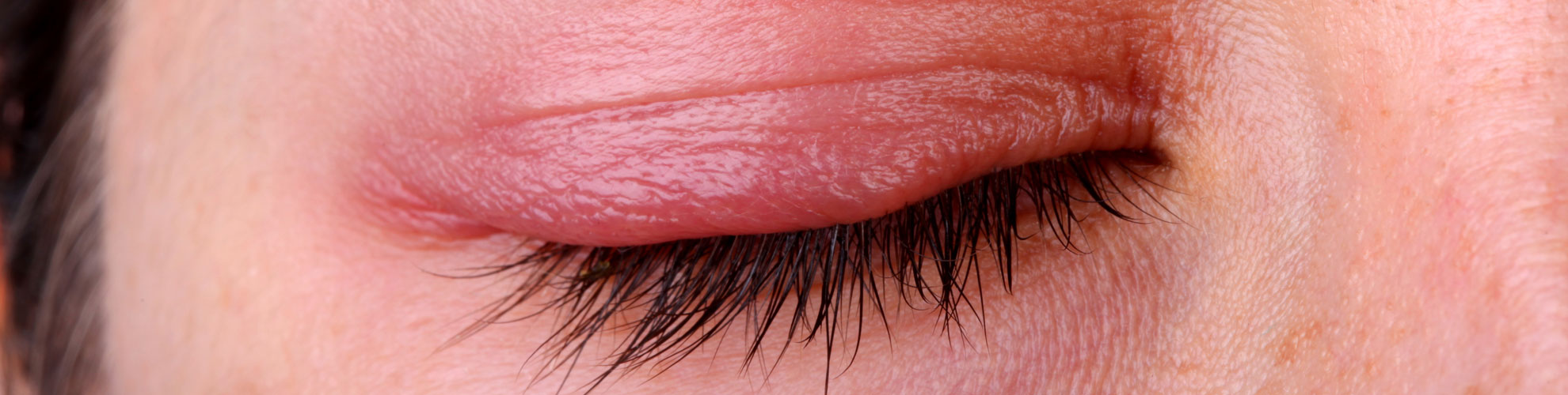 blepharitis